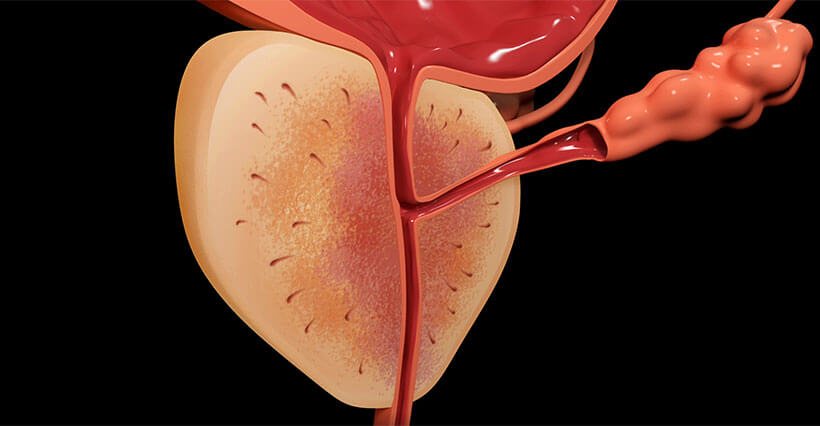 Illustration der Prostata / Prostatakrebs