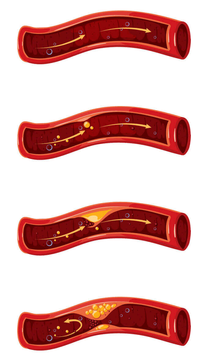 Darstellung einer Arterie mit fortschreitender Arterienverkalkung (Arteriosklerose). Früherkennung durch Kardio-CT Computertomographie.