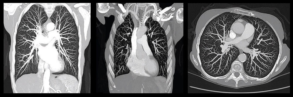 Kardio-CT-Bilder des menschlichen Oberkörpers zeigen detaillierte Ansichten des Herzens und der feinen Gefäßstrukturen in der Lunge.