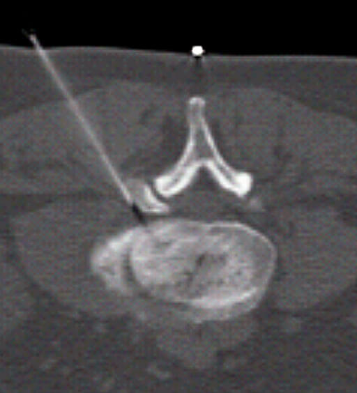 Schmerzbehandlung Radiologie in Gießen: Epidurale Wirbelsäulenonfiltration