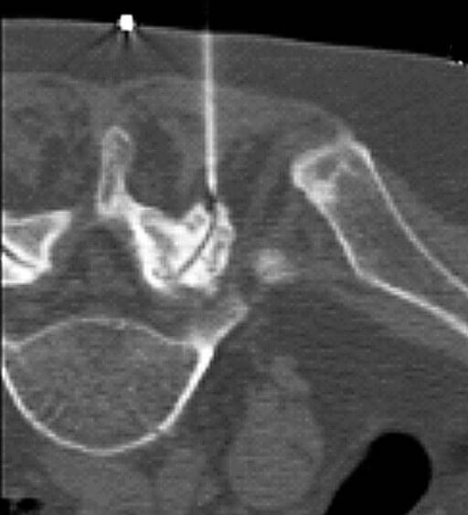 Facettengelenkinfiltration CT-Bild, Schmerzbehandlung der radiologie in Gießen