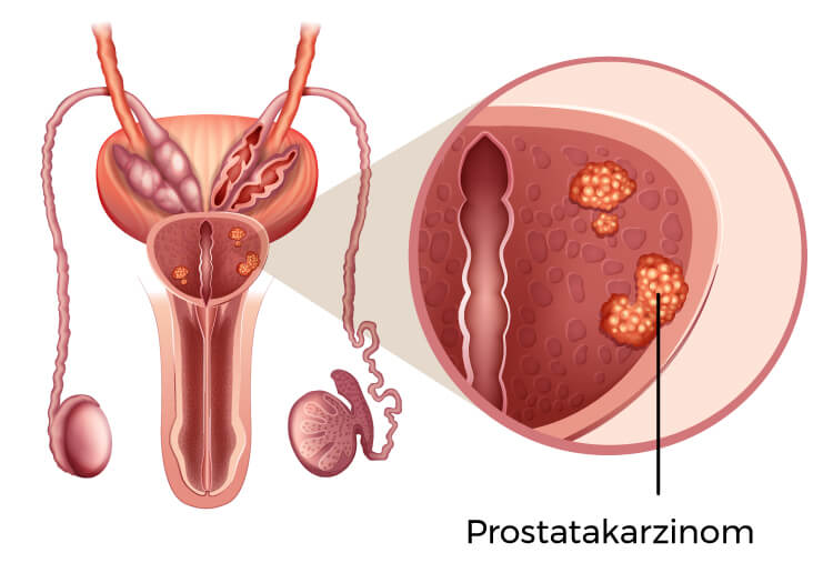 Prostata - Prostatakrebs - Prostatakarzinom