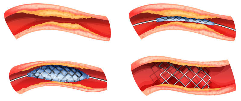 Illustration des Einsetzens eines Stents in eine Arterie: Der Stent wird mithilfe eines Ballons eingeführt, die Arterie erweitert und der Stent fixiert.