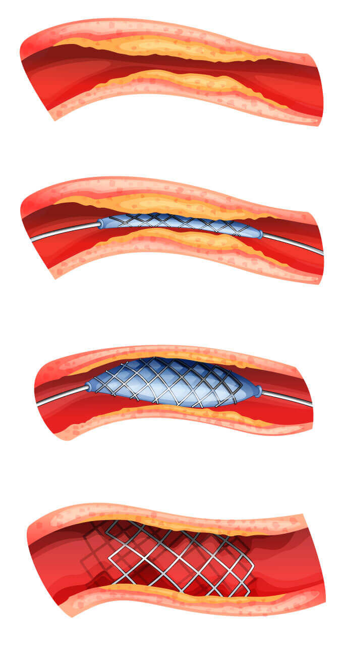 Illustration des Einsetzens eines Stents in eine Arterie: Der Stent wird mithilfe eines Ballons eingeführt, die Arterie erweitert und der Stent fixiert.