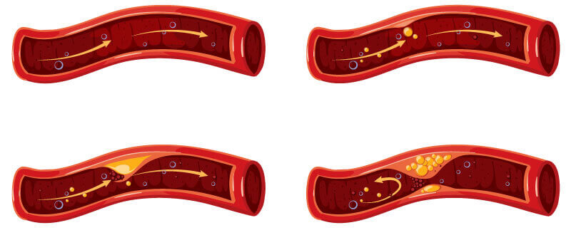 Darstellung einer Arterie mit fortschreitender Arterienverkalkung (Arteriosklerose). Früherkennung durch Kardio-CT Computertomographie.