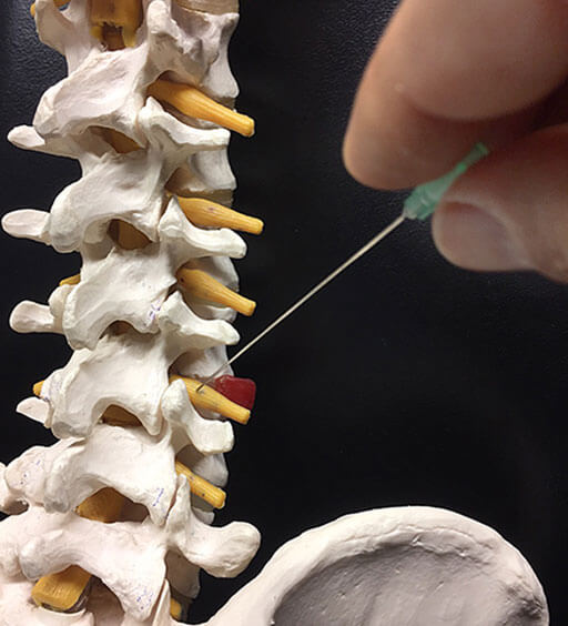 Periradikuläre Therapie (PRT) Schaubild Modell - Schmerztherapie, Schmerzbehandlung Radiologie